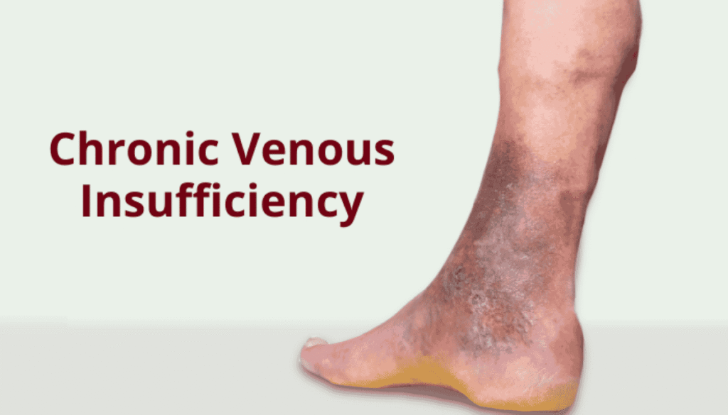Venus Insufficiency