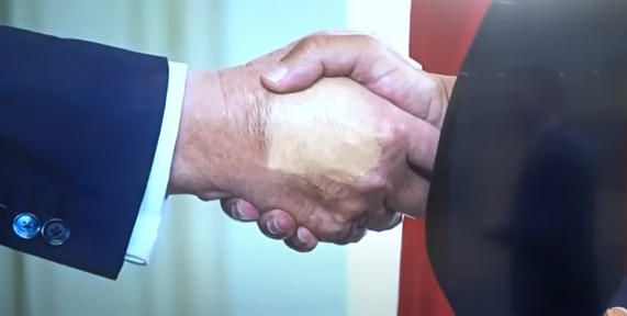 Trump diagnosed with Chronic Venus insufficiency