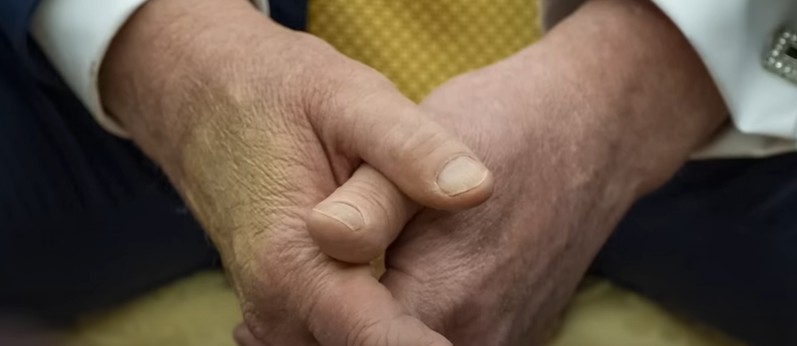 Trump diagnosed with Chronic Venus insufficiency