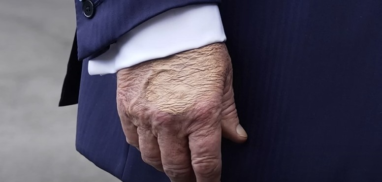 Trump diagnosed with Chronic Venus insufficiency