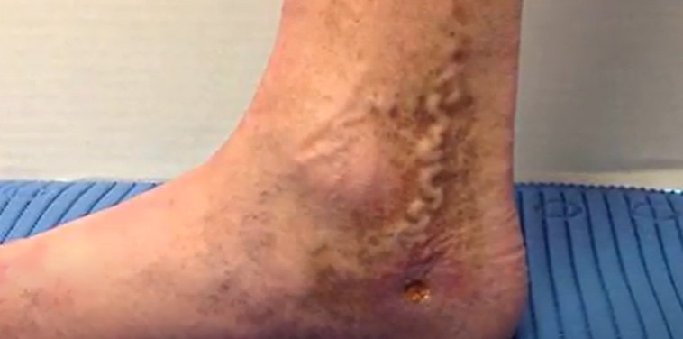 Chronic Venous Insufficiency