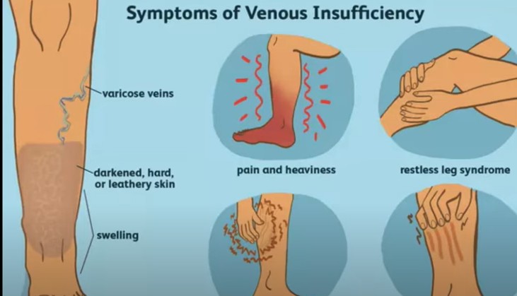 Chronic Venous Insufficiency
