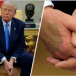 Trump diagnosed with Chronic Venus insufficiency