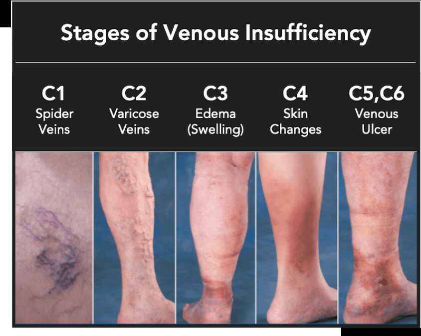 Chronic Venous Insufficiency (CVI)